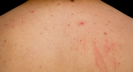 back-acne-02